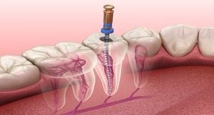 root cannel arrow