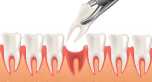 tooth extraction arr