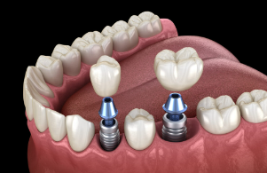 Blog-The-Arrow-Dental-Clinic-06-12-2025_02_19_PM